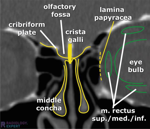 CT sinus